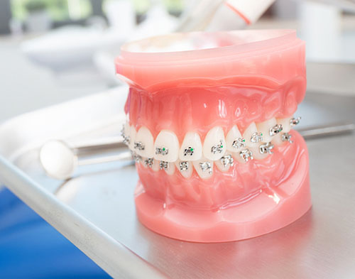 Dental model with braces